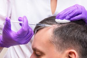 PRP Hair Loss Treatment in Doral FL