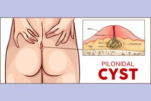 Pilonidal Cyst Treatment at FaceBeauty Med Spa in Doral, FL