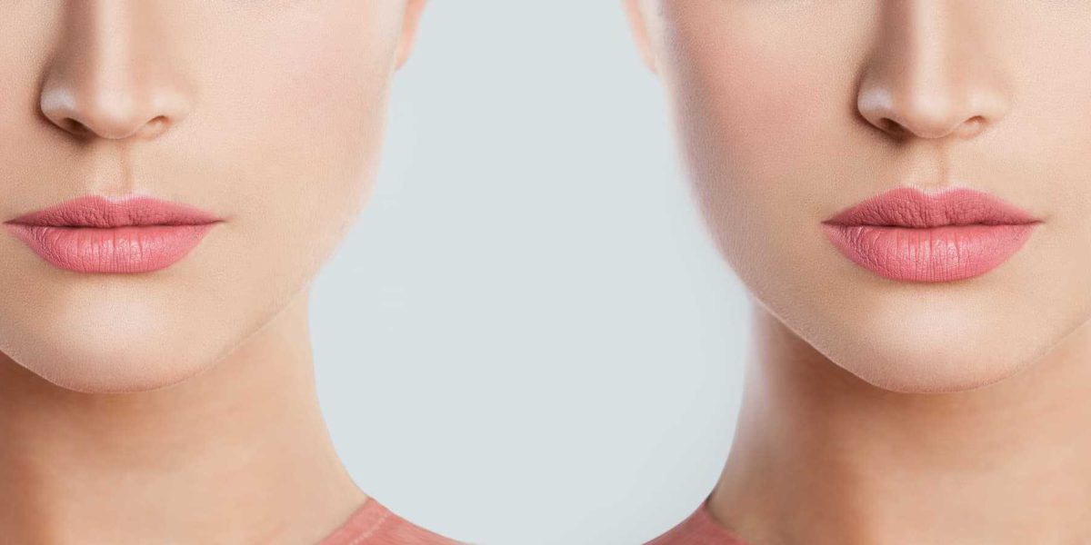 Before and After - Lip Filler - FaceBeauty Med Spa in Doral, FL