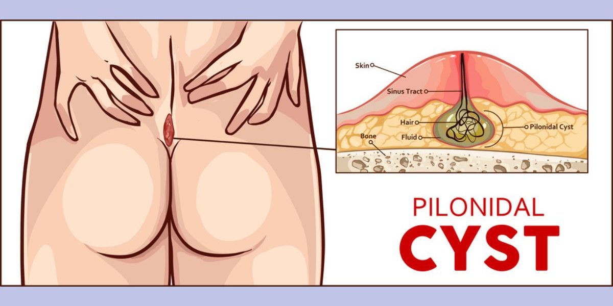 Pilonidal Cyst Treatment at FaceBeauty Med Spa in Doral, FL